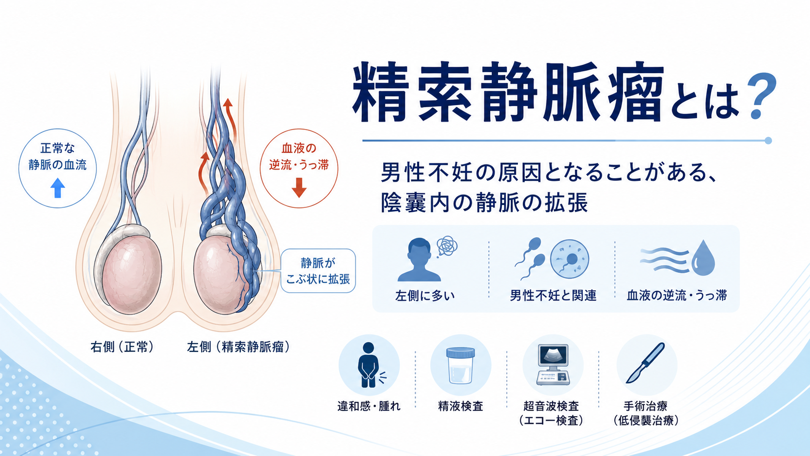 精索静脈瘤とは?男性不妊の最多原因を泌尿器科専門医が解説